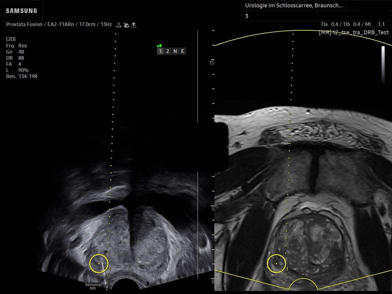 Screenshot Fusionsbiopsie der Prostata